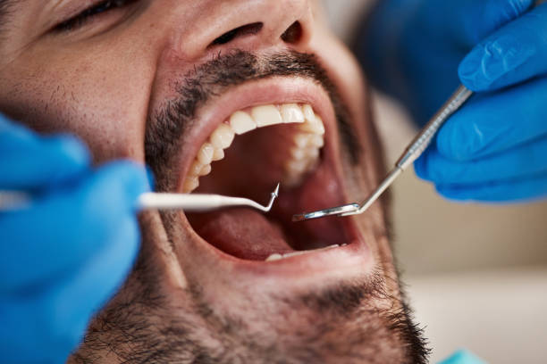 Best Urgent Care for Lost Fillings or Crowns in Isla Vista, CA